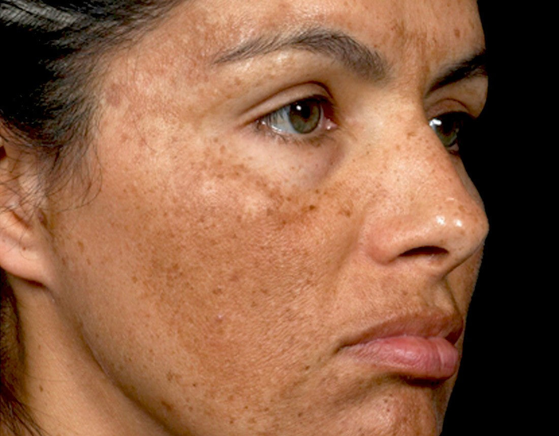 Pigmentation & Melasma